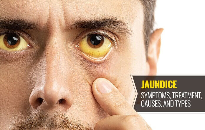 Everything That You Should Know About Jaundice: Causes, Symptoms, Diet And Its Prevention