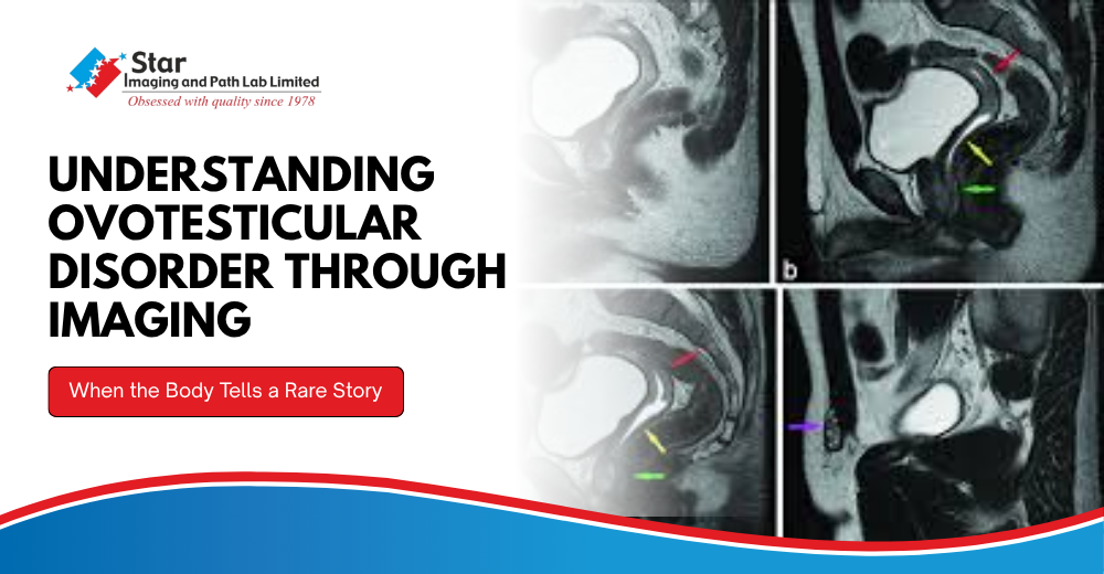 Ovotesticular Disorder Diagnosis with MRI | Star Imaging and Path Lab Limited