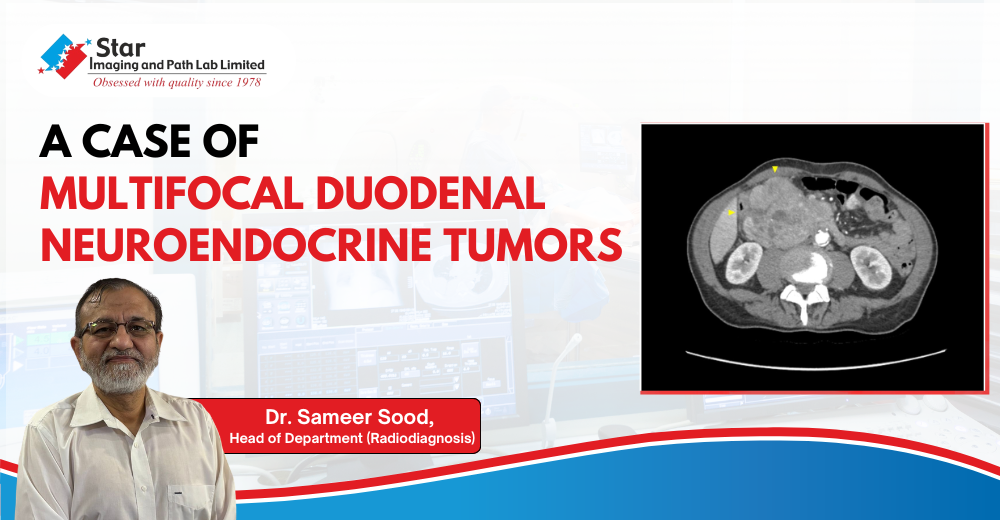 From Mild Discomfort to Discovery: A Case of Multifocal Duodenal Neuroendocrine Tumors