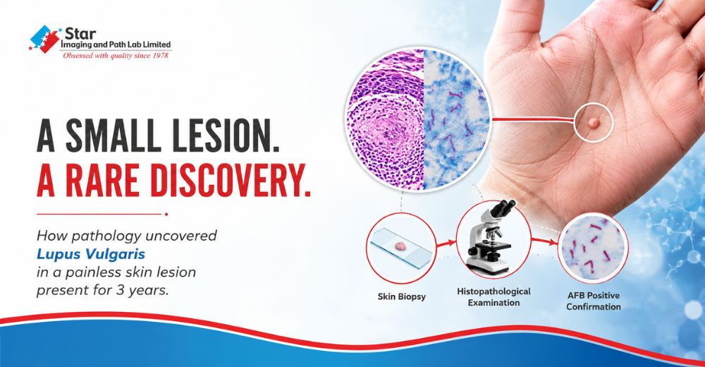 When a Quiet Skin Lesion Revealed an Uncommon Diagnosis: A Rare Case of Lupus Vulgaris Confirmed at Star Imaging and Path Lab Limited
